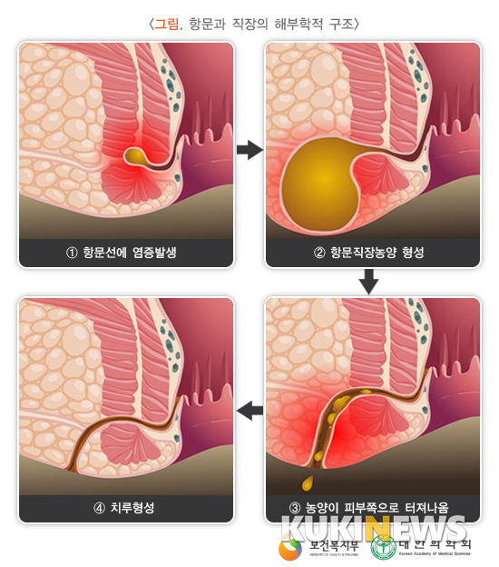 항문주위농양이 치루로 발전하는 과정. 그림= 국가건강정보포탈